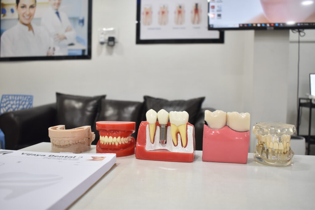 Best Dental Implants in Hyderabad
